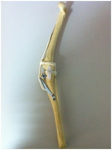 Рис. 4. макет коленного сустава с установленными имплантами.