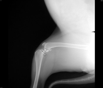 Рентгенограмма. Разрыв ПКС. Линиями показано смещение голени, относительно мыщелков бедра, за счет разрыва передней крестообразной связки.
